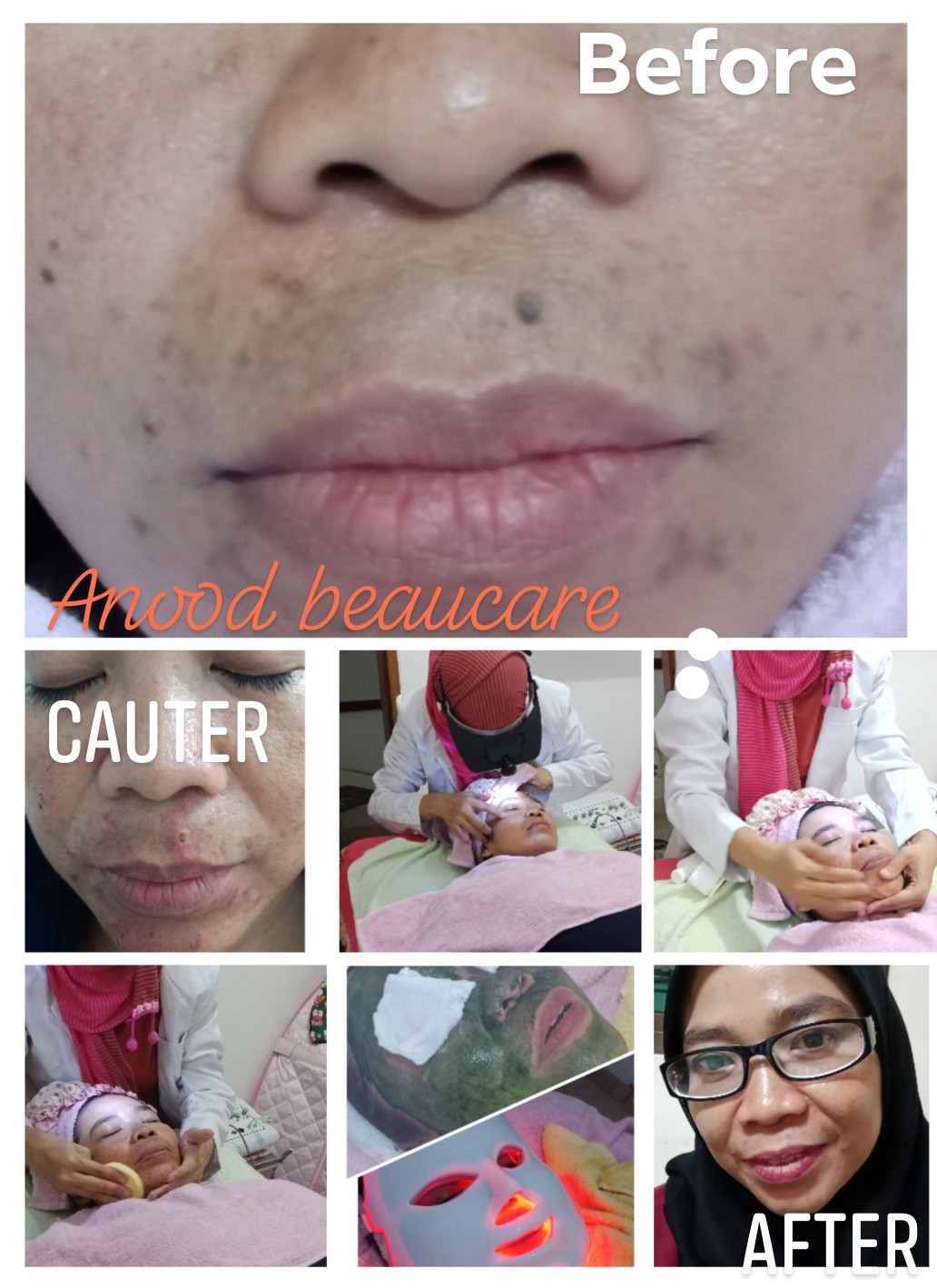 Promo Terapi Bekam
